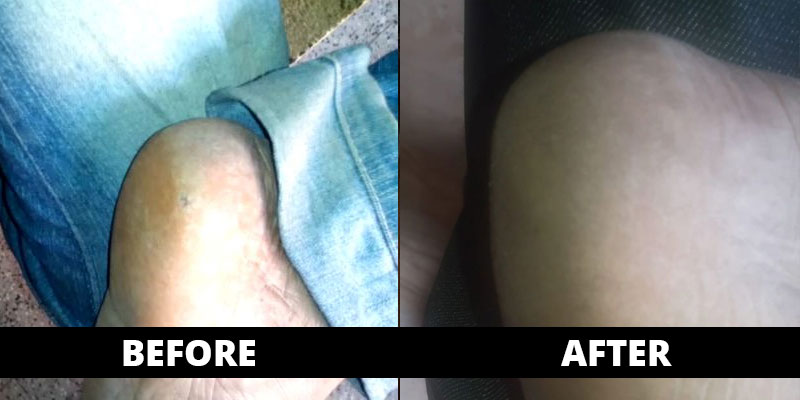 Corn cured (before-after) with homoeopathy treatment