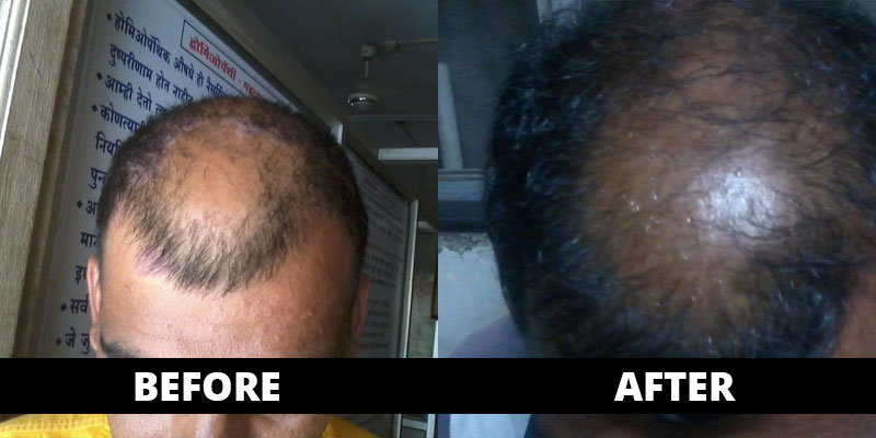 Hair Fall cured (before-after) with homoeopathy treatment