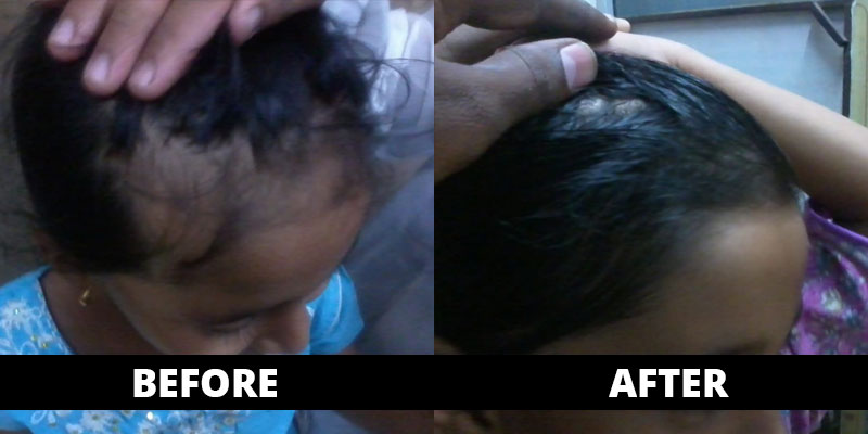 Hair Fall cured (before-after) with homoeopathy treatment