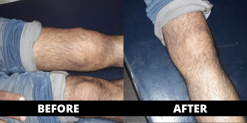 Knee / Joint Swelling cured (before-after) with homoeopathy treatment