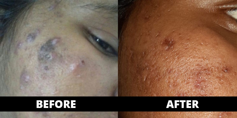 Pimples cured (before-after) with homoeopathy treatment