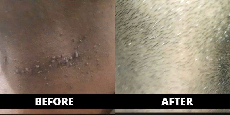 Warts cured (before-after) with homoeopathy treatment
